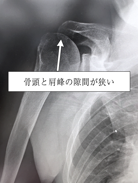 人工肩関節置換術 | 聖マリアンナ医科大学 整形外科学講座