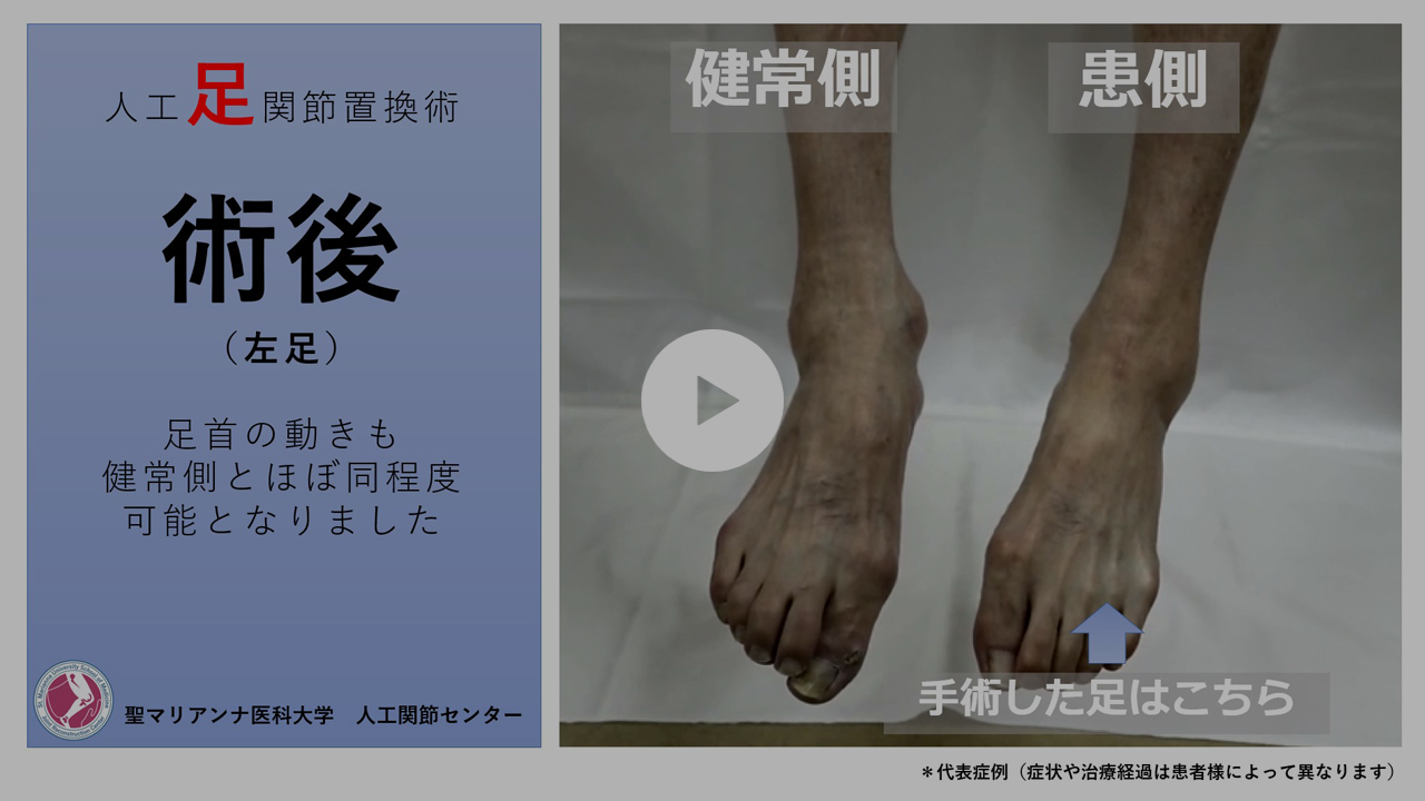 人工足関節置換術 | 聖マリアンナ医科大学 整形外科学講座