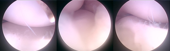 テニス肘の関節鏡手術