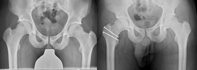 FAIとsurgical hip dislocation後
